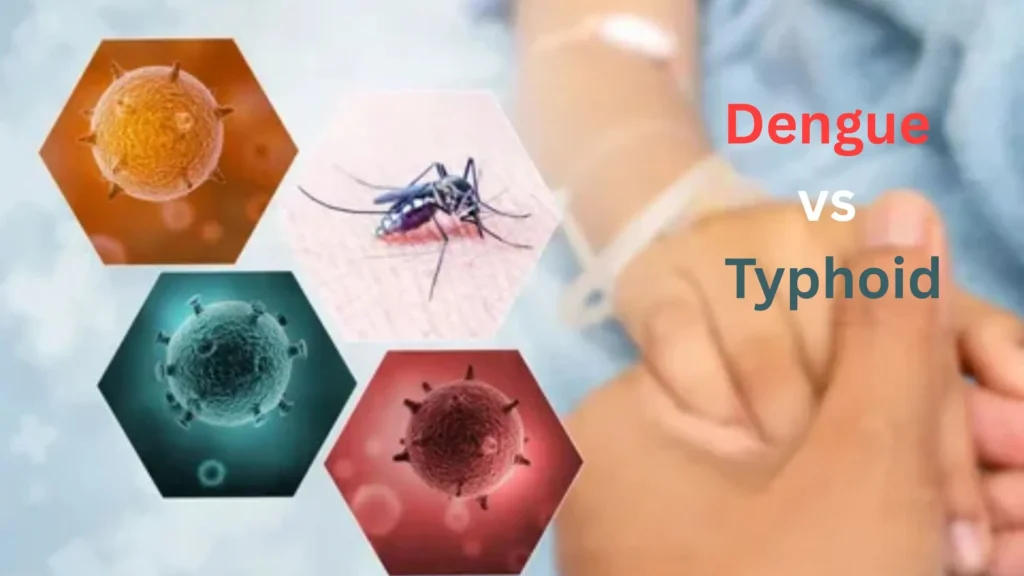 Dengue vs Typhoid