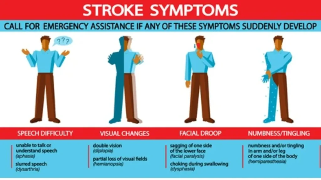 symptoms of stroke