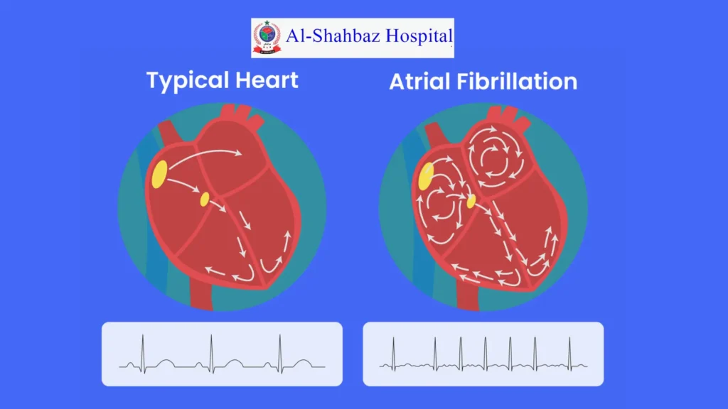 Atrial Fibrillation