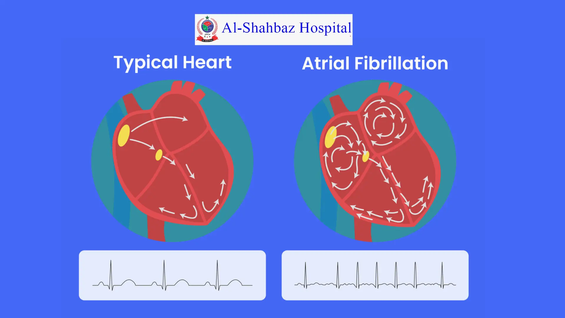 Atrial Fibrillation